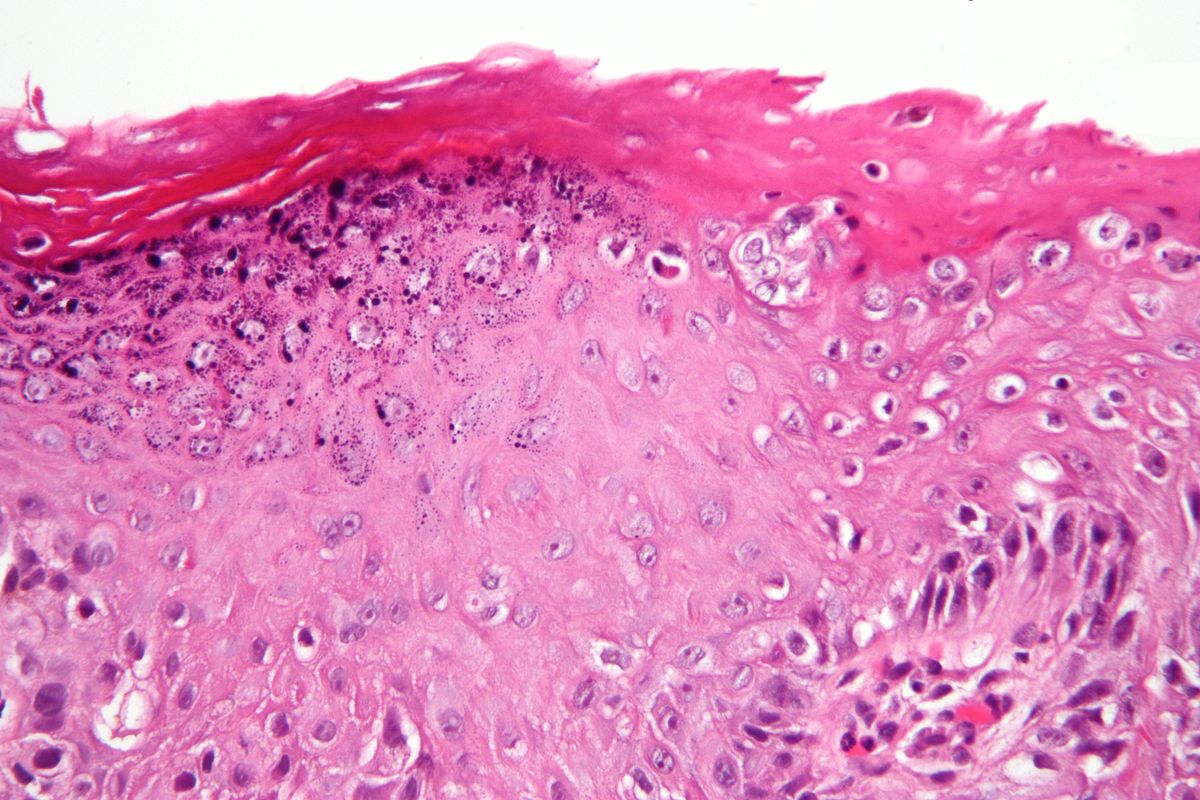 La Melanina ¿Amiga O Enemiga? - Microbacterium