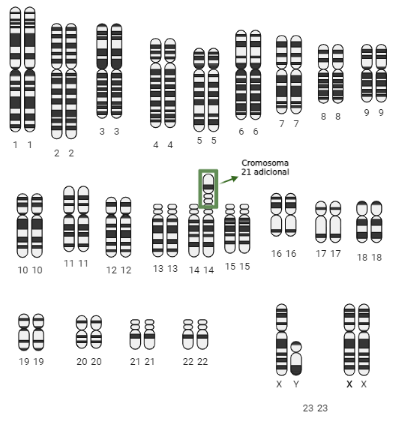Cariotipo de una persona con síndrome de Down familiar. En este ejemplo, la translocación se produjo entre los cromosomas 14 y 21, generando un cromosoma fusionado que proporciona una tercera copia del 21.