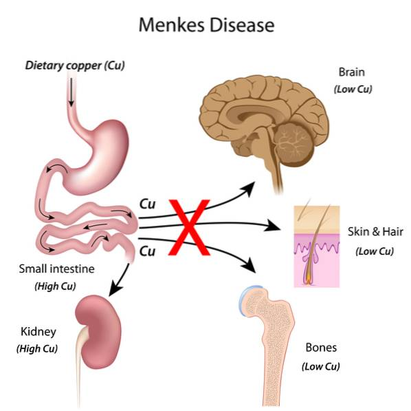 La mala distribución del cobre (Cu) en el cuerpo humano es la causa principal de la sintomatología en la enfermedad de Menkes. 