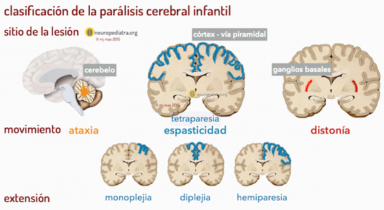 Parálisis cerebral: lo que la ciencia quiere que entendamos más allá de los mitos 1 parálisis cerebral